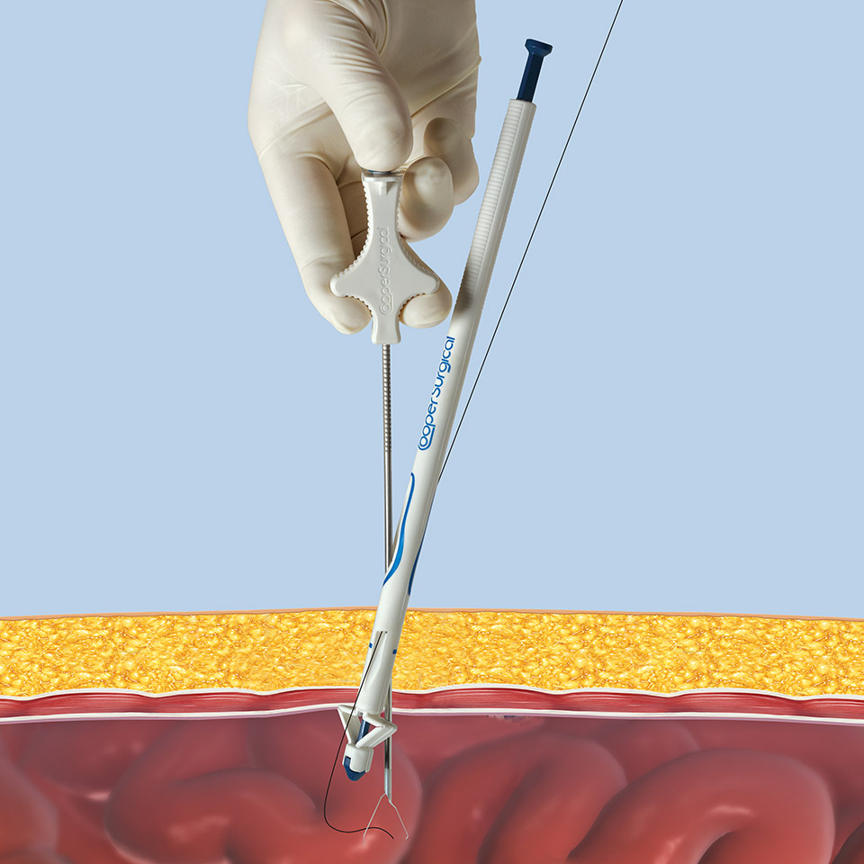 CooperSurgical